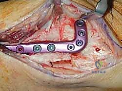 خطوات إجراء عملية قطع العظم فوق الكاحل