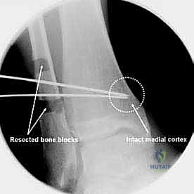 التشخيص الدقيق لتشوهات الكاحل بالأشعة