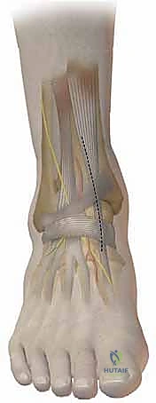 صورة توضيحية لـ قطع العظم فوق الكاحل الحل الأمثل لتشوهات الكاحل وآلامه المزمنة