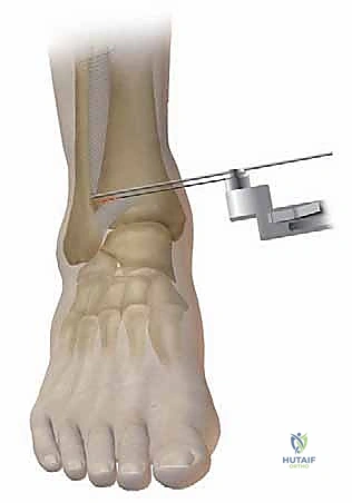 Supramalleolar Osteotomy: An Intraoperative Masterclass for Ankle Deformity Correction