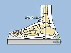 توضيح منطقة الميتافيزيس المستهدفة