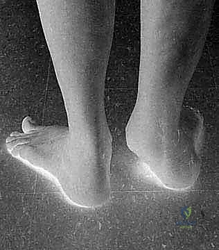 قطع العظم فوق الكاحل بالتثبيت الخارجي تصحيح تشوهات الساق البعيدة مع الأستاذ الدكتور محمد هطيف