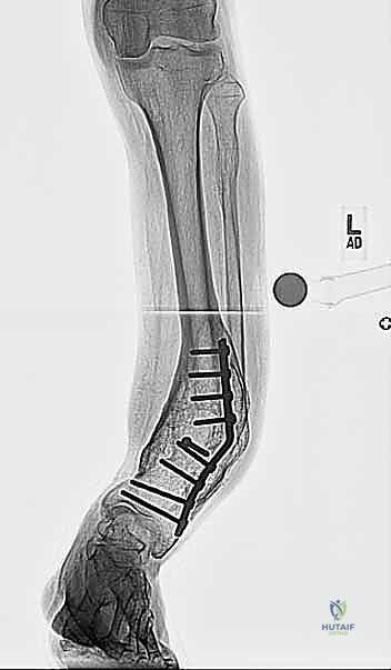 تأثير الكساح على عظام الساق