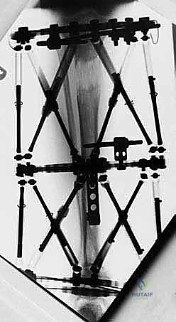 الأعصاب والأوعية الدموية في الساق