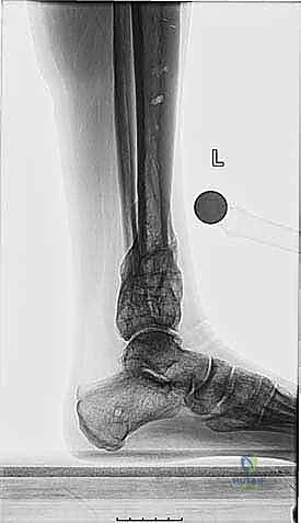 تأثير التهاب العظام على الساق