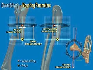 تطبيق تقنيات التثبيت الخارجي المتقدمة