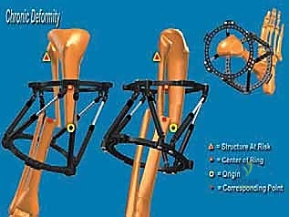 تحديد زوايا التشوه ونقطة CORA