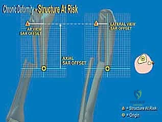 التخطيط الإشعاعي قبل الجراحة