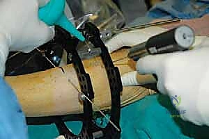 صورة توضيحية لـ قطع العظم فوق الكاحل بالتثبيت الخارجي تصحيح تشوهات الساق البعيدة مع الأستاذ الدكتور محمد هطيف