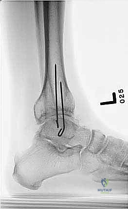 خطوة قطع عظمة الشظية