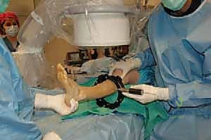 صورة توضيحية لـ قطع العظم فوق الكاحل بالتثبيت الخارجي تصحيح تشوهات الساق البعيدة مع الأستاذ الدكتور محمد هطيف