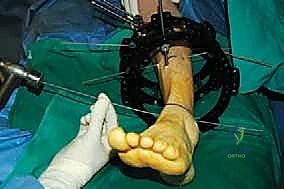 صورة توضيحية لـ قطع العظم فوق الكاحل بالتثبيت الخارجي تصحيح تشوهات الساق البعيدة مع الأستاذ الدكتور محمد هطيف