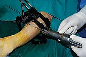 صورة توضيحية لـ قطع العظم فوق الكاحل بالتثبيت الخارجي تصحيح تشوهات الساق البعيدة مع الأستاذ الدكتور محمد هطيف