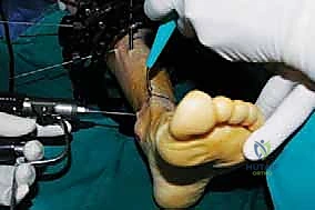 صورة توضيحية لـ قطع العظم فوق الكاحل بالتثبيت الخارجي تصحيح تشوهات الساق البعيدة مع الأستاذ الدكتور محمد هطيف