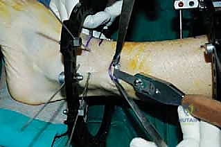 صورة طبية: قطع العظم فوق الكاحل بالتثبيت الخارجي تصحيح تشوهات الساق البعيدة مع الأستاذ الدكتور محمد هطيف