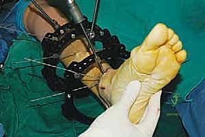 صورة طبية: قطع العظم فوق الكاحل بالتثبيت الخارجي تصحيح تشوهات الساق البعيدة مع الأستاذ الدكتور محمد هطيف