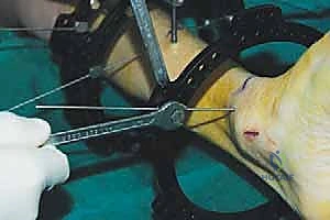 صورة طبية: قطع العظم فوق الكاحل بالتثبيت الخارجي تصحيح تشوهات الساق البعيدة مع الأستاذ الدكتور محمد هطيف