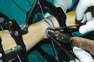 صورة طبية: قطع العظم فوق الكاحل بالتثبيت الخارجي تصحيح تشوهات الساق البعيدة مع الأستاذ الدكتور محمد هطيف