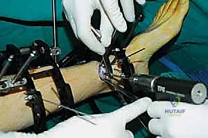 صورة طبية: قطع العظم فوق الكاحل بالتثبيت الخارجي تصحيح تشوهات الساق البعيدة مع الأستاذ الدكتور محمد هطيف