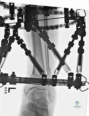 صورة طبية: قطع العظم فوق الكاحل بالتثبيت الخارجي تصحيح تشوهات الساق البعيدة مع الأستاذ الدكتور محمد هطيف