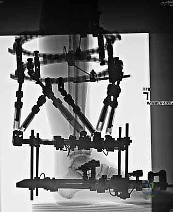 صورة طبية: قطع العظم فوق الكاحل بالتثبيت الخارجي تصحيح تشوهات الساق البعيدة مع الأستاذ الدكتور محمد هطيف