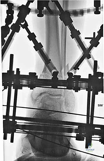 صورة طبية: قطع العظم فوق الكاحل بالتثبيت الخارجي تصحيح تشوهات الساق البعيدة مع الأستاذ الدكتور محمد هطيف