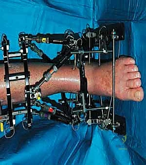 صورة طبية: قطع العظم فوق الكاحل بالتثبيت الخارجي تصحيح تشوهات الساق البعيدة مع الأستاذ الدكتور محمد هطيف