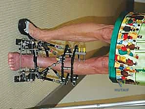 صورة طبية: قطع العظم فوق الكاحل بالتثبيت الخارجي تصحيح تشوهات الساق البعيدة مع الأستاذ الدكتور محمد هطيف