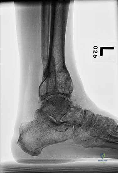 صورة طبية: قطع العظم فوق الكاحل بالتثبيت الخارجي تصحيح تشوهات الساق البعيدة مع الأستاذ الدكتور محمد هطيف