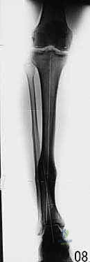 صورة طبية: قطع العظم فوق الكاحل بالتثبيت الخارجي تصحيح تشوهات الساق البعيدة مع الأستاذ الدكتور محمد هطيف