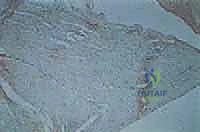 درجات الخلع الوركي التطوري لدى الأطفال