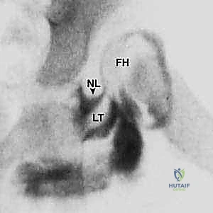 الفحص السريري لخلع الورك التطوري