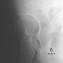 صورة أشعة تشخيصية توضح خلع الورك التطوري