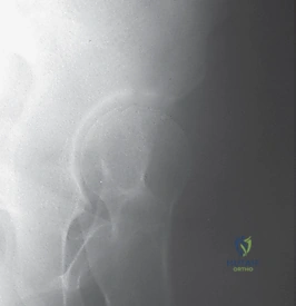 صورة توضيحية لـ الخلع الوركي التطوري (DDH) عند الأطفال: دليل شامل للنهج الأمامي للرد المفتوح مع الأستاذ الدكتور محمد هطيف