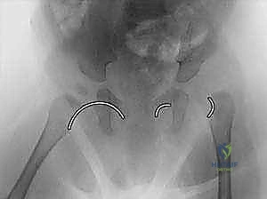 تشريح مفصل الورك والخلع التطوري