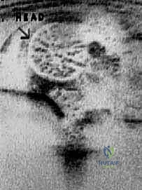 الخلع الوركي التطوري (DDH) عند الأطفال: دليل شامل للنهج الأمامي للرد المفتوح مع الأستاذ الدكتور محمد هطيف