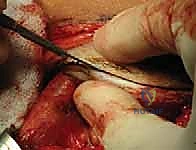 إعادة رأس الفخذ إلى مكانه الطبيعي