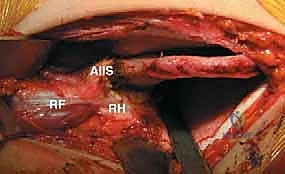 خياطة وشد الكبسولة المفصلية