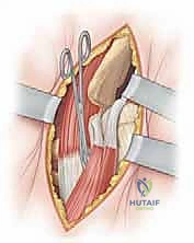 إزالة العوائق من التجويف الحقي