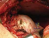 التحضير للتدخل الجراحي والرد المفتوح