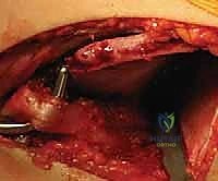 النهج الأمامي في جراحة الرد المفتوح