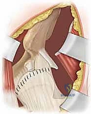 صورة توضيحية لـ الخلع الوركي التطوري (DDH) عند الأطفال: دليل شامل للنهج الأمامي للرد المفتوح مع الأستاذ الدكتور محمد هطيف