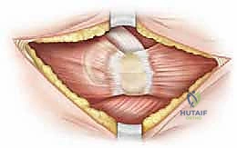 التعامل مع الأنسجة الرخوة بدقة