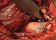 تثبيت المفصل المؤقت أثناء العملية