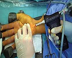 Mastering Carpal Tunnel Release: An Intraoperative Guide to Open and Endoscopic Techniques