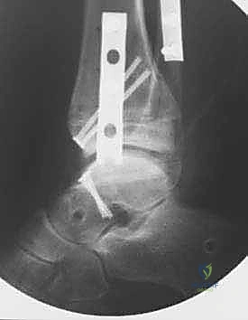 التصوير الإشعاعي داخل العمليات للتأكد من المحاذاة