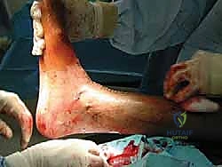 تطابق مثالي للغضروف المزروع