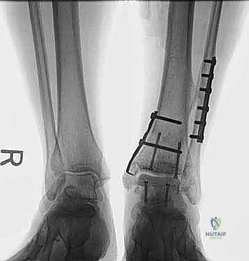 التأكد من التروية الدموية للطعم
