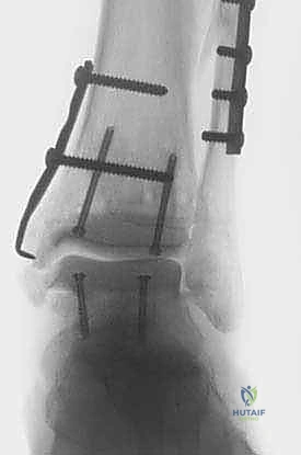 صورة مقربة لسطح المفصل بعد الزراعة