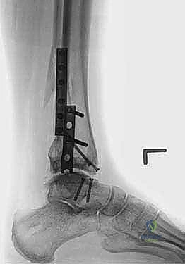 استخدام البراغي الدقيقة للتثبيت